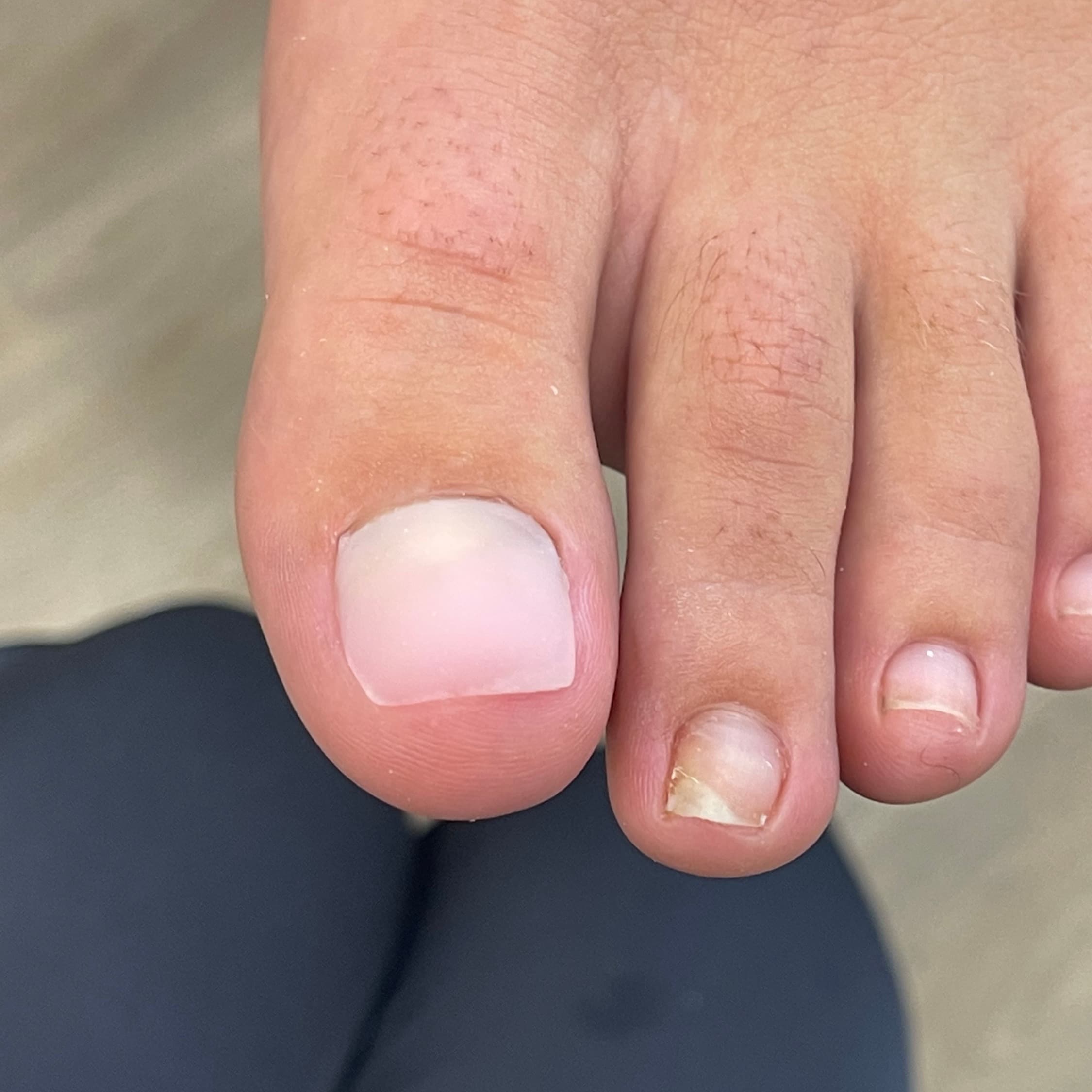 Toenail restoration — after