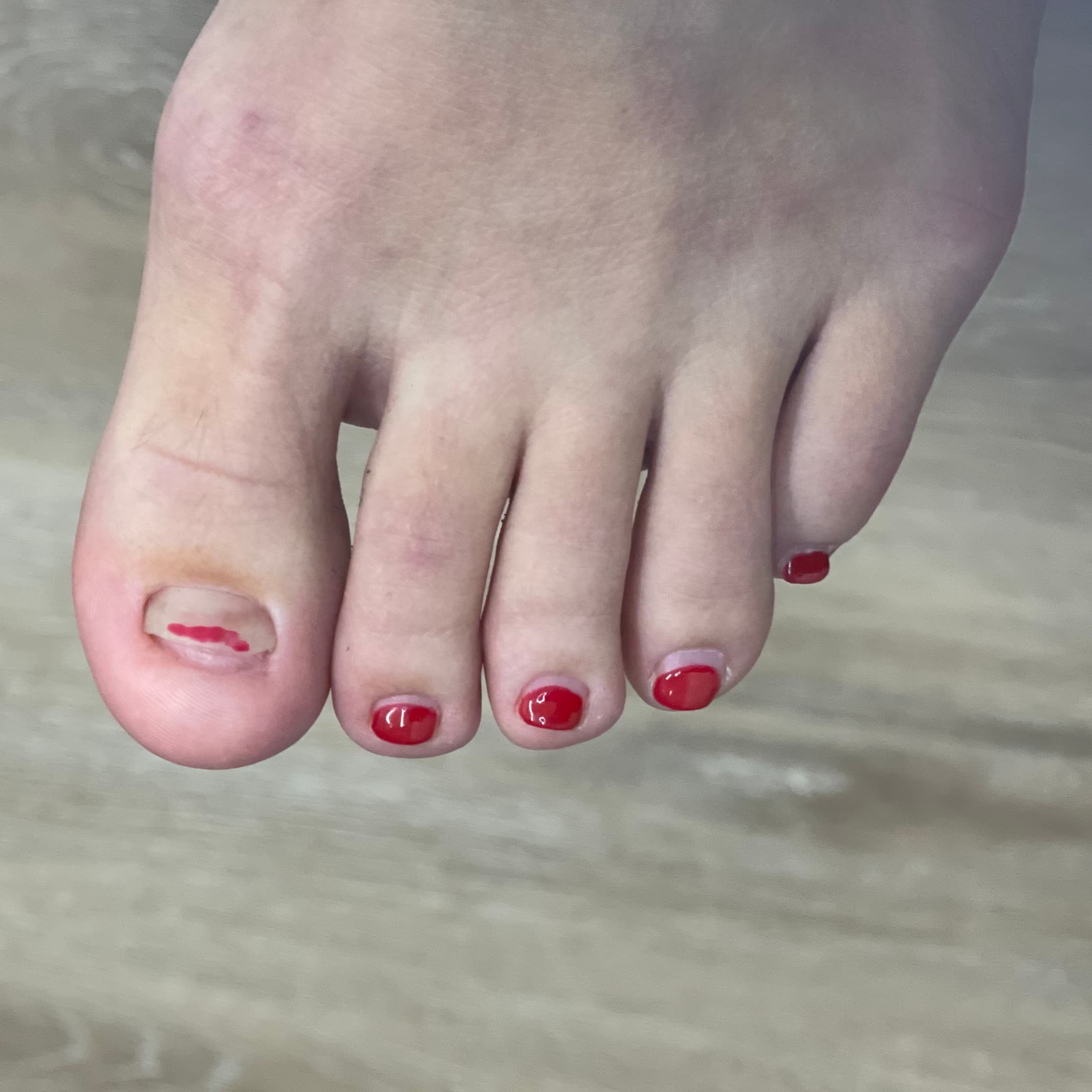 Toenail restoration — before