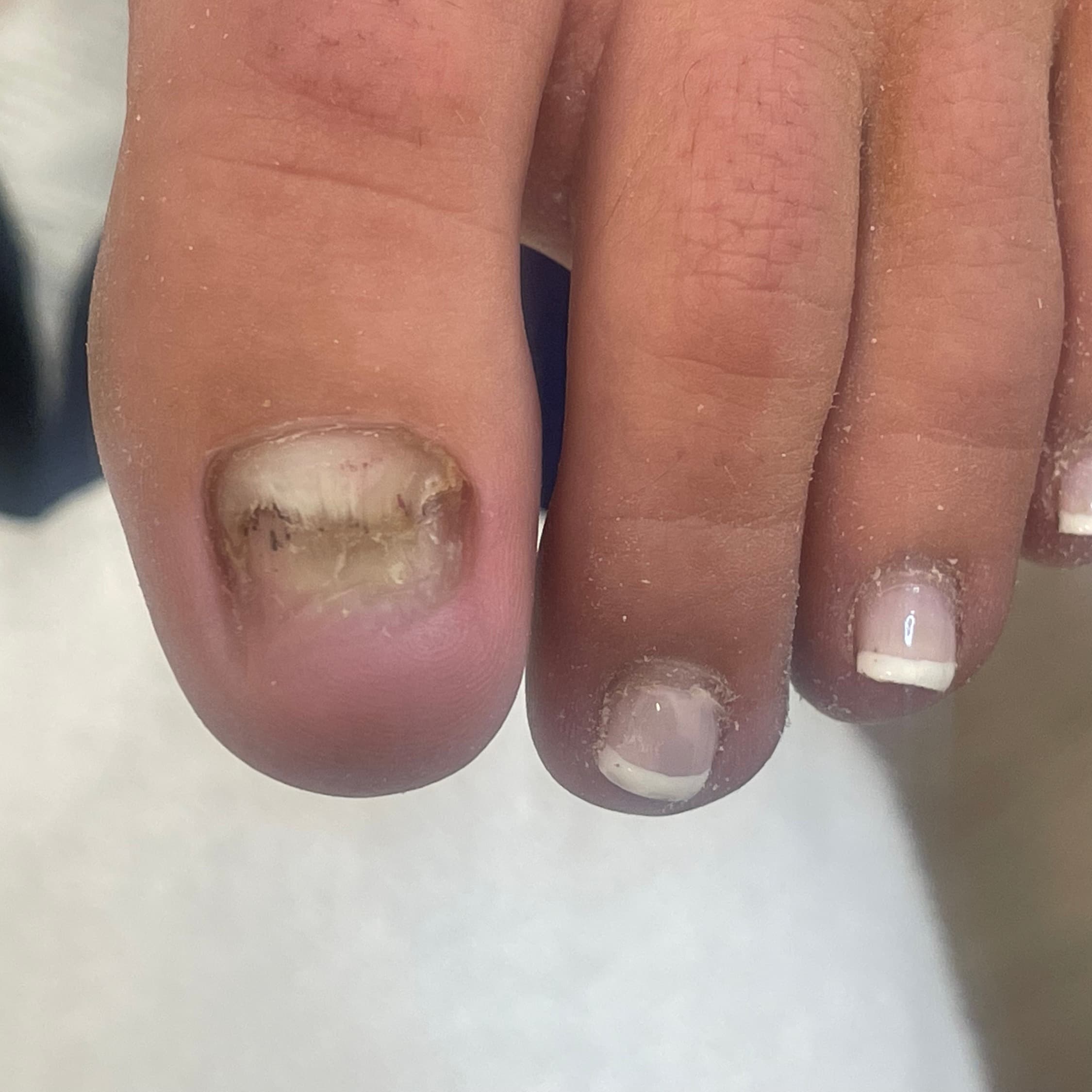 Toenail restoration — before